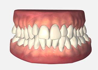 Front view of a 3D intraoral scan